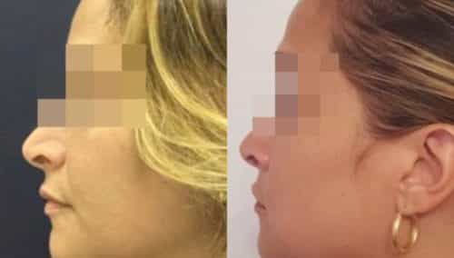 facial fat grafting colombia 286 - 3-min