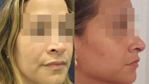 facial fat grafting colombia 286 - 4-min
