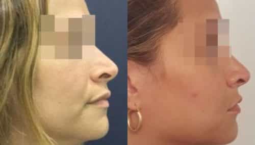 facial fat grafting colombia 286 - 5-min