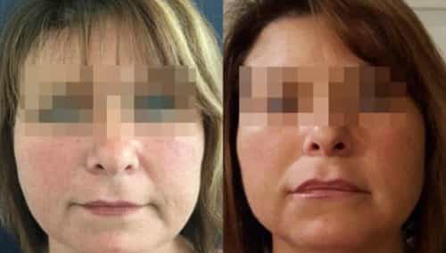 facial fat grafting colombia 294 - 1-min