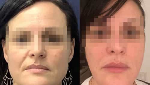facial fat grafting colombia 317 - 1-min