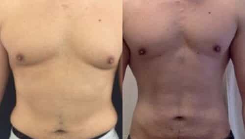 male reduction colombia 223-1-min