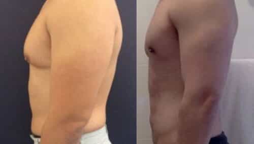 male reduction colombia 223-3-min