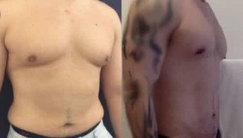 male reduction colombia 223-4-min