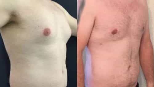 male reduction colombia 258-4-min