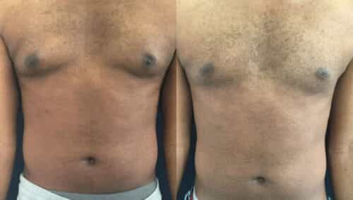 male reduction colombia 319-1-min