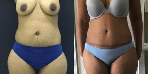 mommy makeover colombia 101-1-min