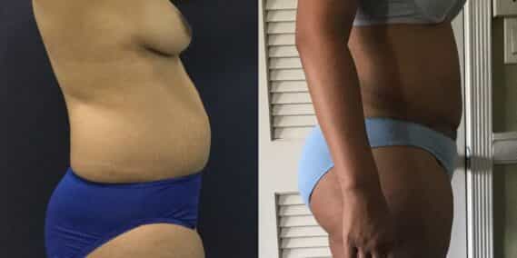 mommy makeover colombia 101-3-min