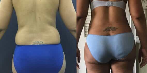mommy makeover colombia 101-4-min