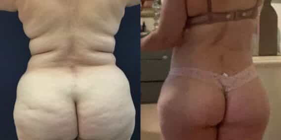 mommy makeover colombia 131-2-min