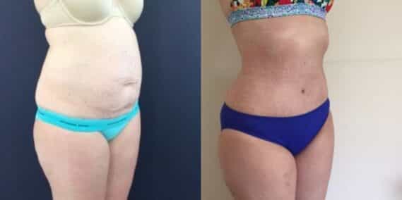 mommy makeover colombia 143-4-min
