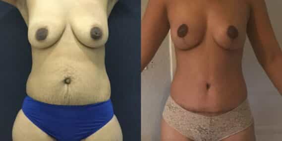 mommy makeover colombia 201-1-min