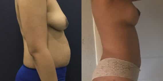 mommy makeover colombia 201-3-min