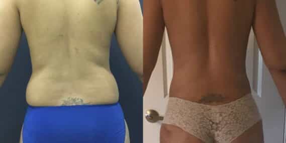 mommy makeover colombia 201-4-min