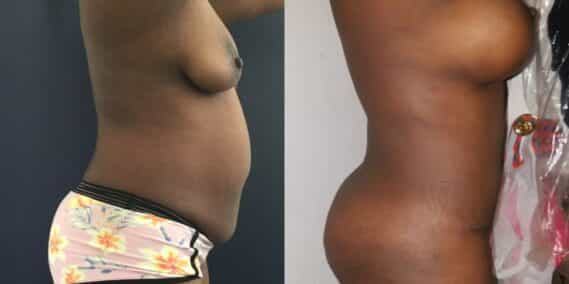 mommy makeover colombia 205-2-min