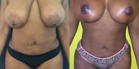 mommy makeover colombia 206-1-min