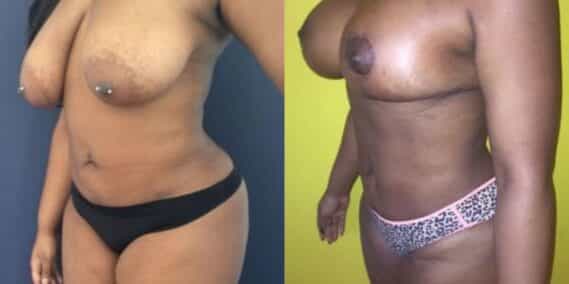 mommy makeover colombia 206-2-min