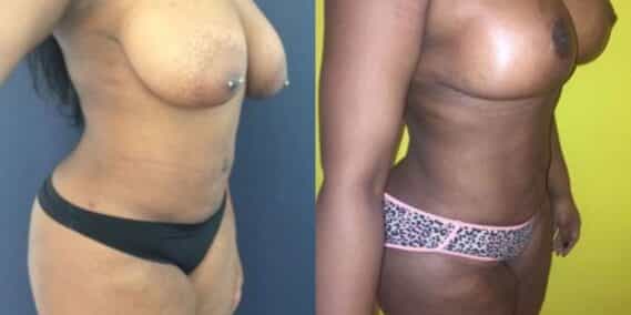 mommy makeover colombia 206-3-min