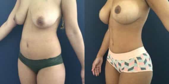 mommy makeover colombia 207-1-min