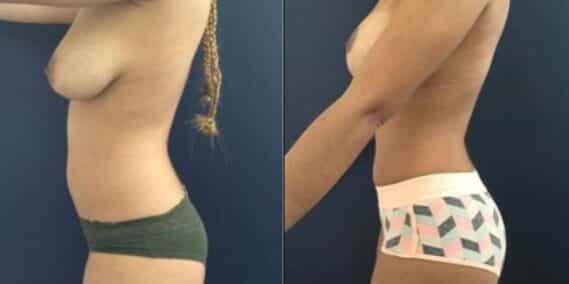 mommy makeover colombia 207-3-min