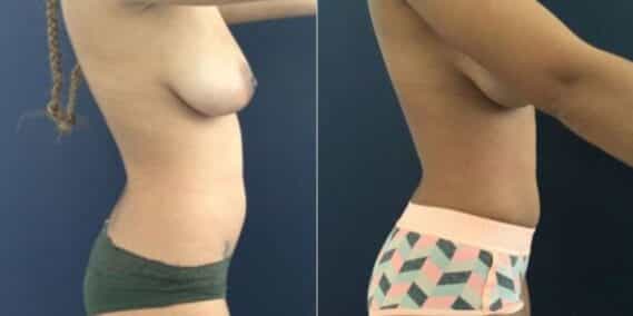 mommy makeover colombia 207-5-min