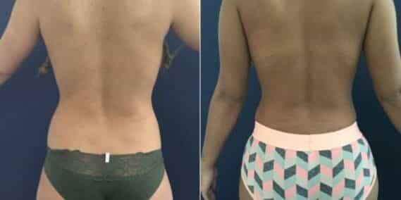 mommy makeover colombia 207-6-min