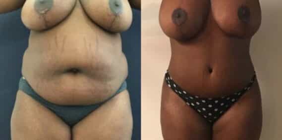 mommy makeover colombia 209-1-min