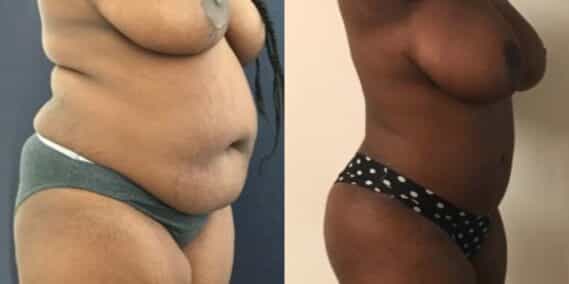 mommy makeover colombia 209-2-min