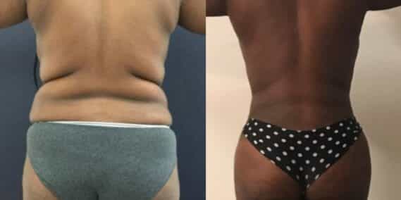 mommy makeover colombia 209-3-min