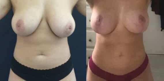 mommy makeover colombia 215-1-min