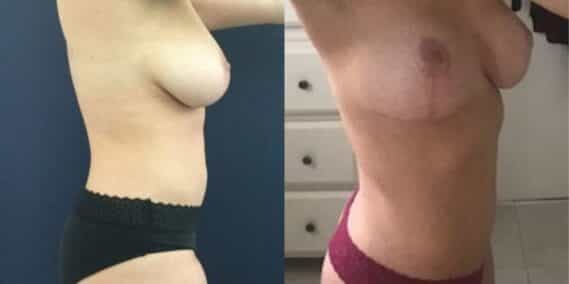 mommy makeover colombia 215-3-min