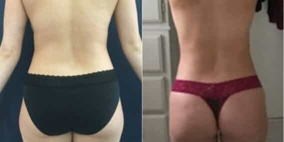 mommy makeover colombia 215-4-min