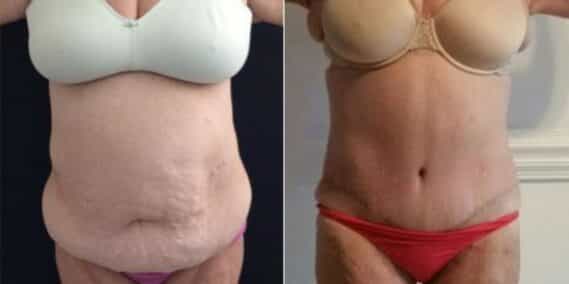mommy makeover colombia 221-1-min