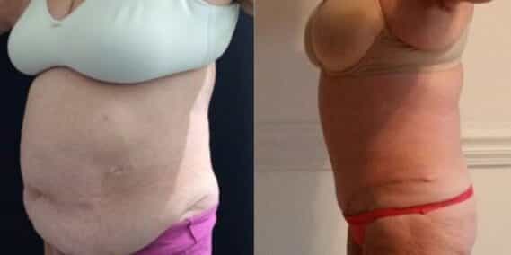 mommy makeover colombia 221-2-min
