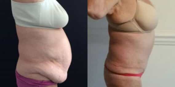 mommy makeover colombia 221-3-min