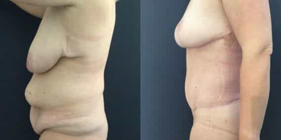 mommy makeover colombia 226-3-min