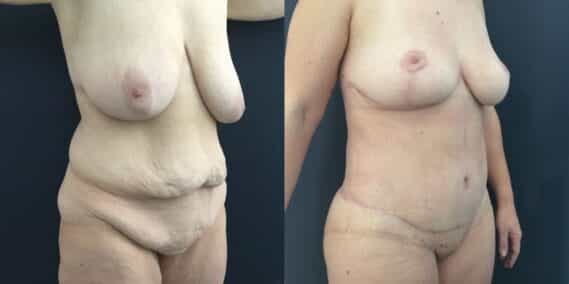 mommy makeover colombia 226-4-min