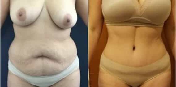 mommy makeover colombia 229-1-min