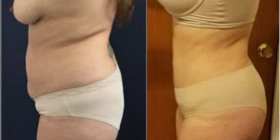 mommy makeover colombia 229-3-min