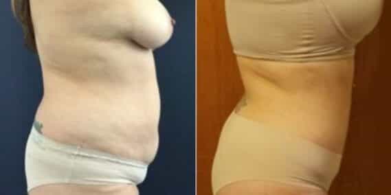mommy makeover colombia 229-4-min