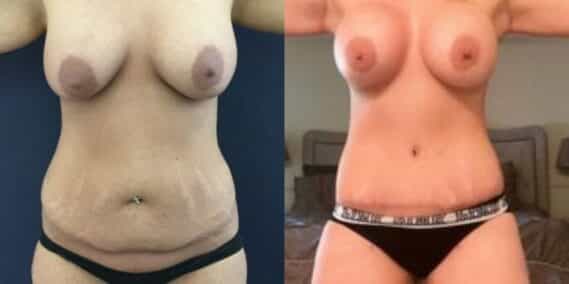 mommy makeover colombia 235-1-min