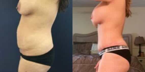 mommy makeover colombia 235-2-min