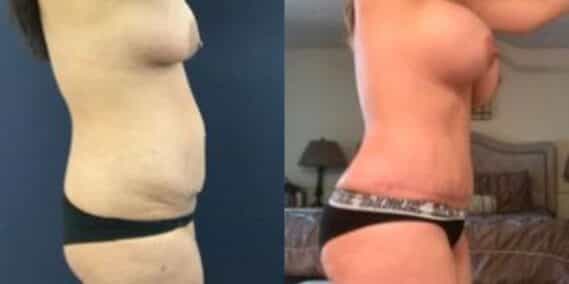 mommy makeover colombia 235-3-min