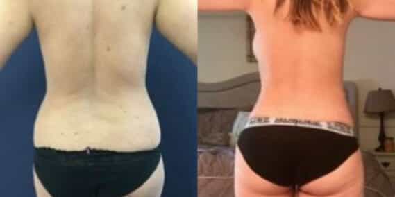 mommy makeover colombia 235-4-min