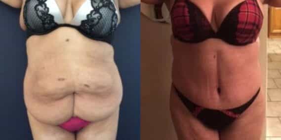 mommy makeover colombia 237-1-min