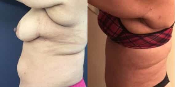 mommy makeover colombia 237-2-min