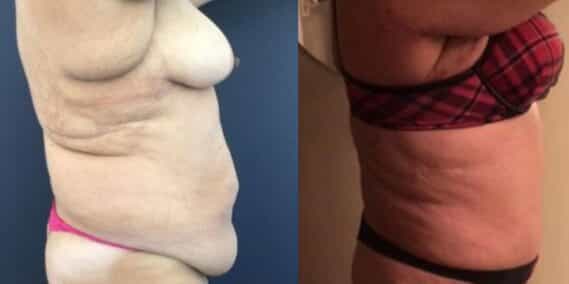 mommy makeover colombia 237-4-min