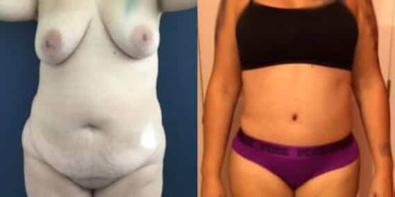 mommy makeover colombia 243-1-min