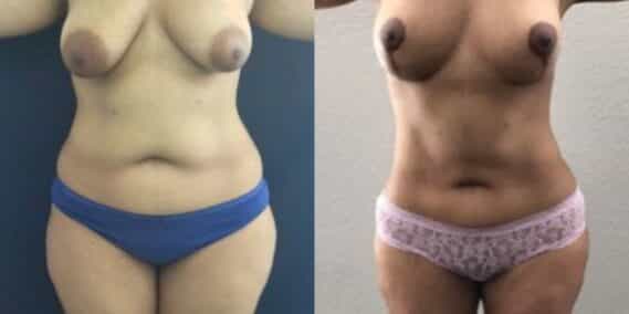 mommy makeover colombia 244-1-min