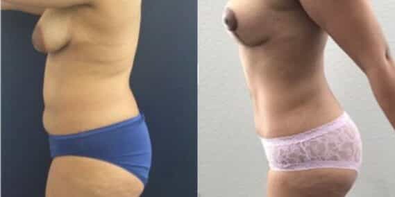 mommy makeover colombia 244-2-min